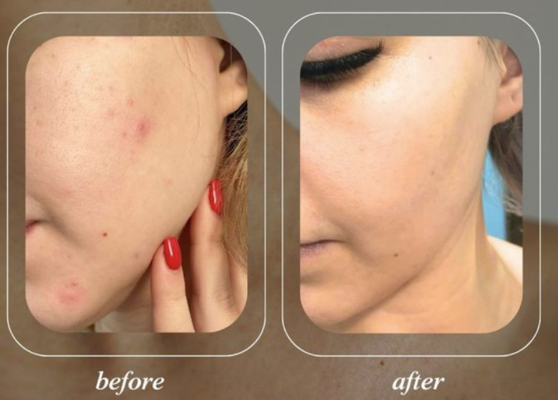 Clinic-supplied acne care before-and-after comparison